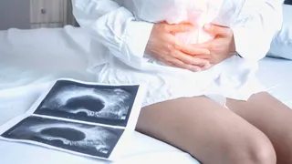 Cáncer de ovario. Infosalus