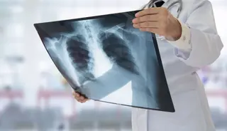 Cáncer de pulmón EP