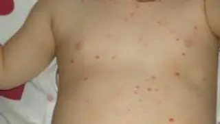 Sanidad estudia levantar el bloqueo a la vacuna de la varicela