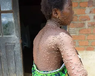 ICAL . Una persona contagiada con mpox en el este de la República Democrática del Congo